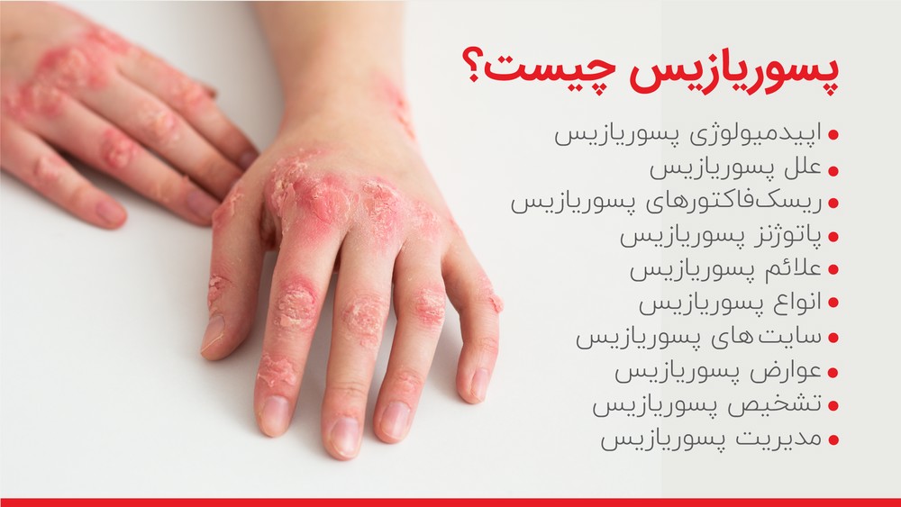 پسوریازیس چیست