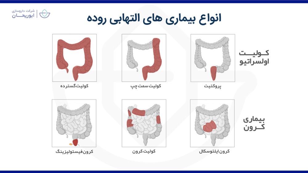 انواع بیماری‌های التهابی روده (IBD) کولیت اولسراتیو بیماری کرون