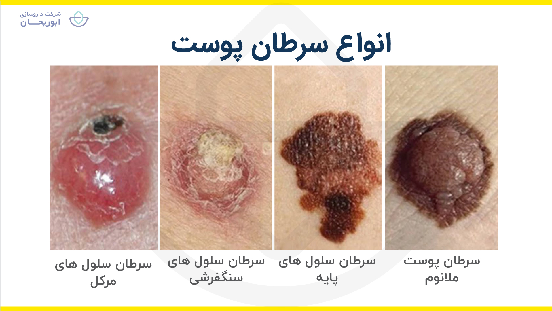 انواع سرطان پوست ملانوما سرطان سلول های پایه سنگفرشی مرکل
