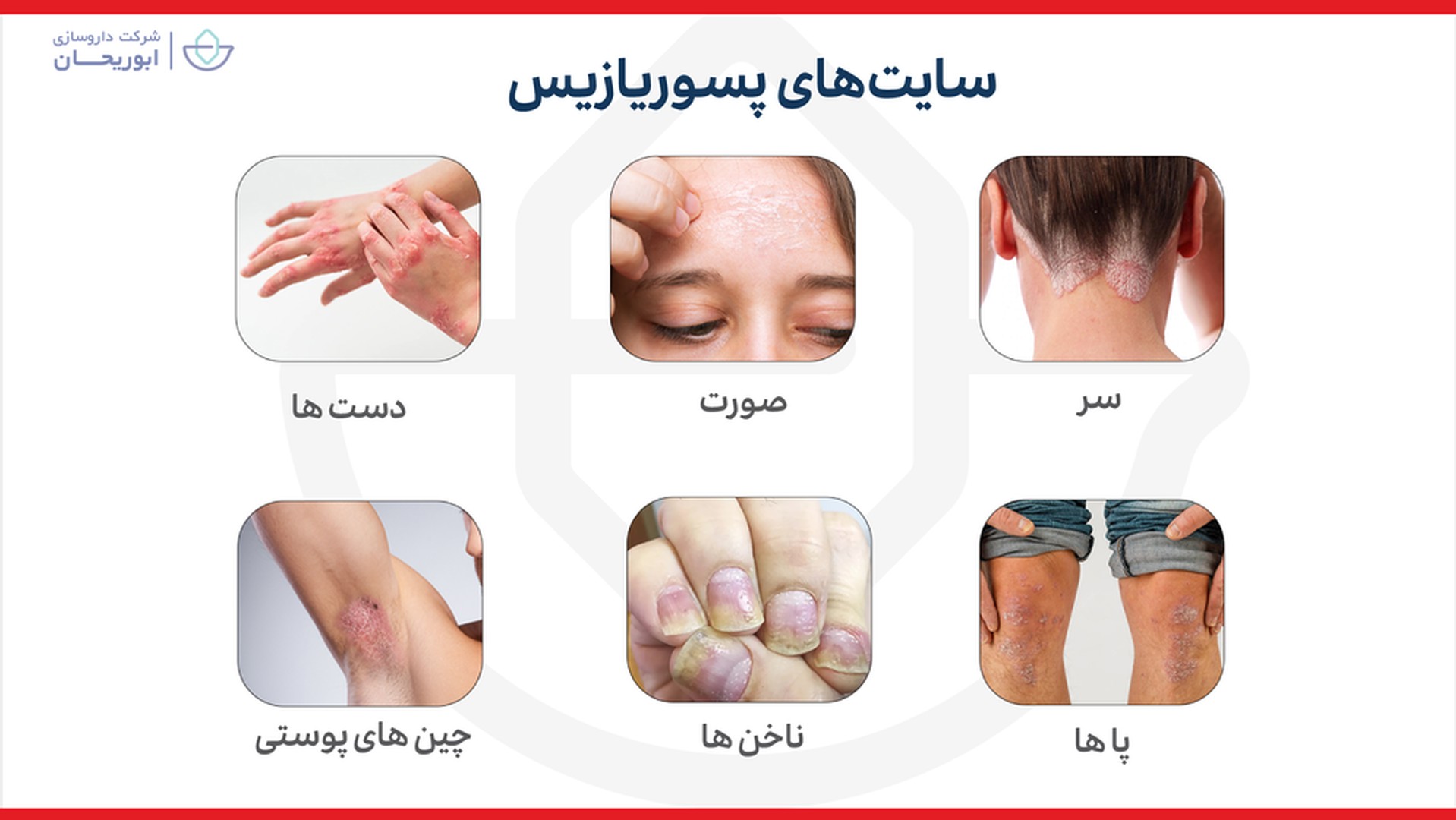 محل پسوریازیس