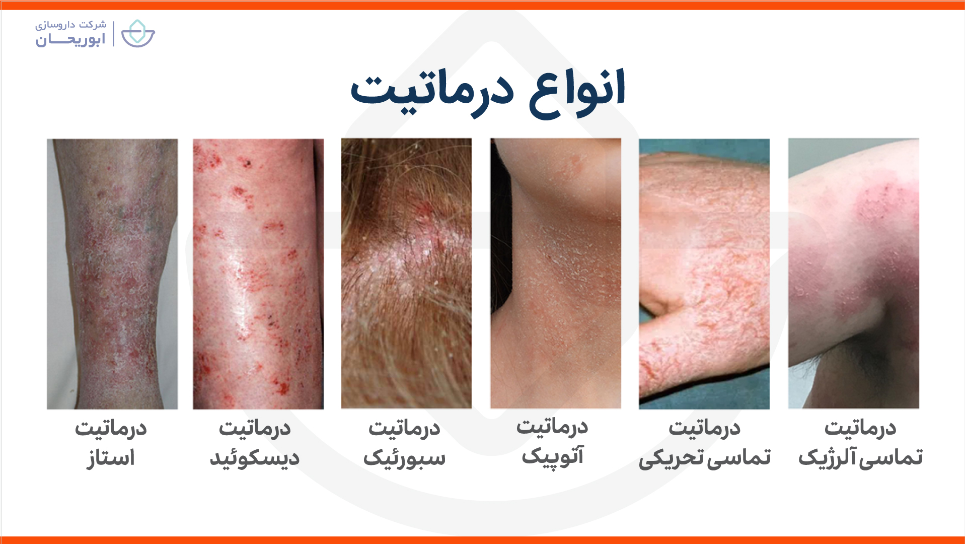انواع درماتیت