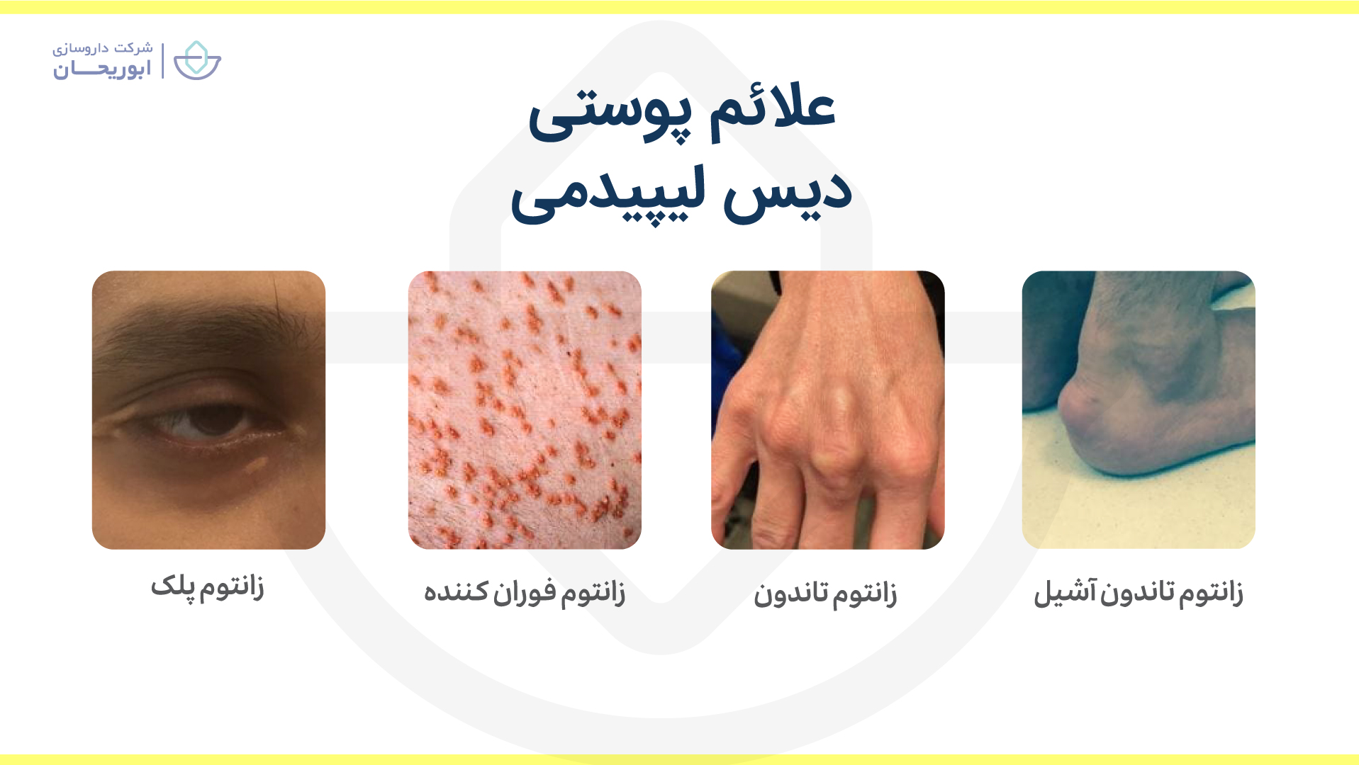 علائم پوستی (زانتوما) اختلال چربی خون (دیس لیپیدمی)