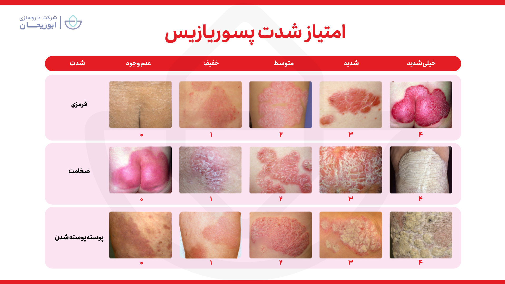 شدت پسوریازیس