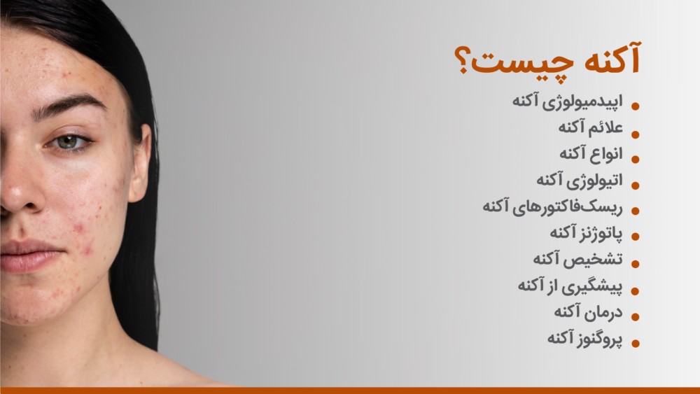 آکنه