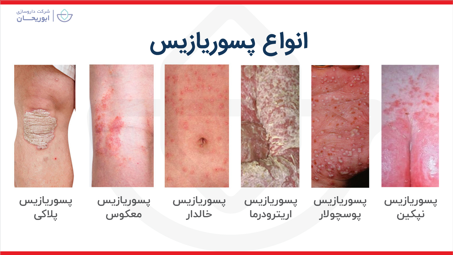 انواع پسوریازیس