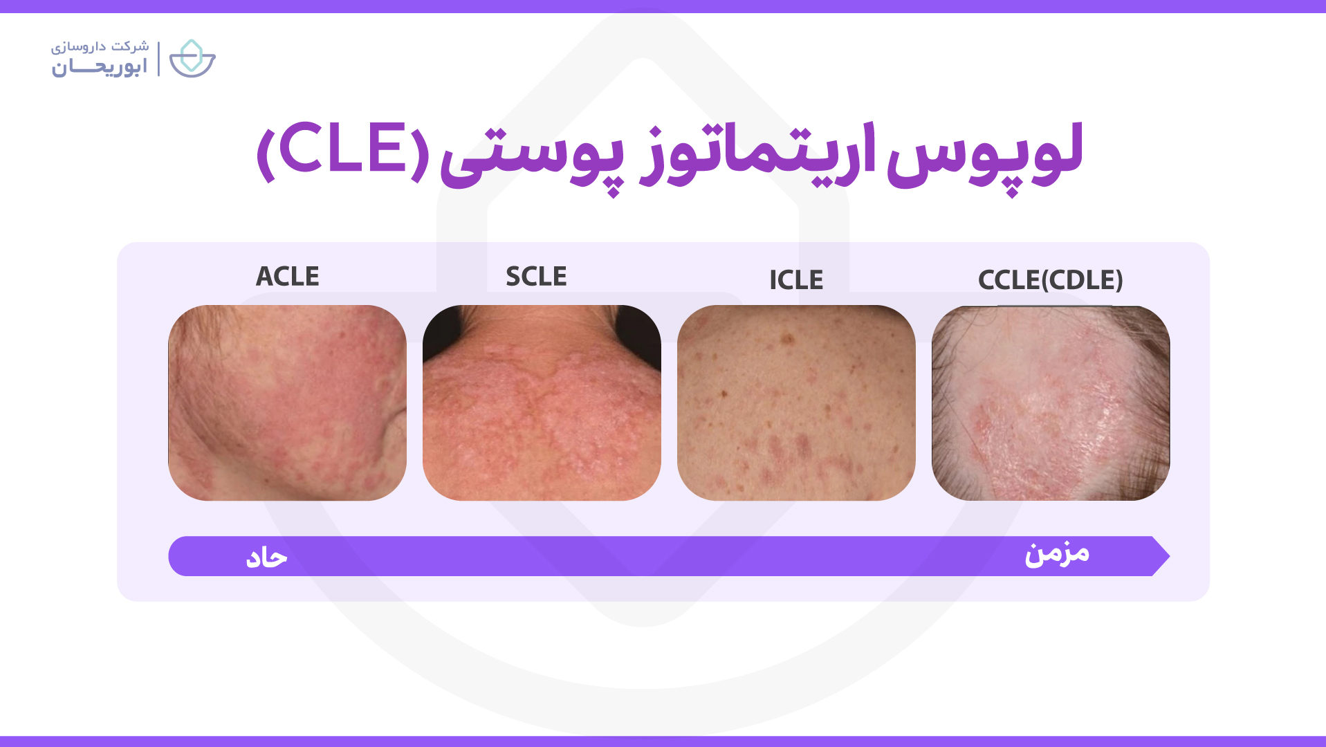 لوپوس اریتماتوز پوستی